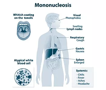 La Mononucleosi Infettiva